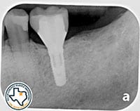 Dental Implants X-Ray After
